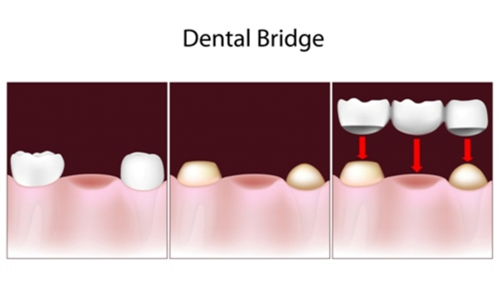 dental bridges in Mahogany