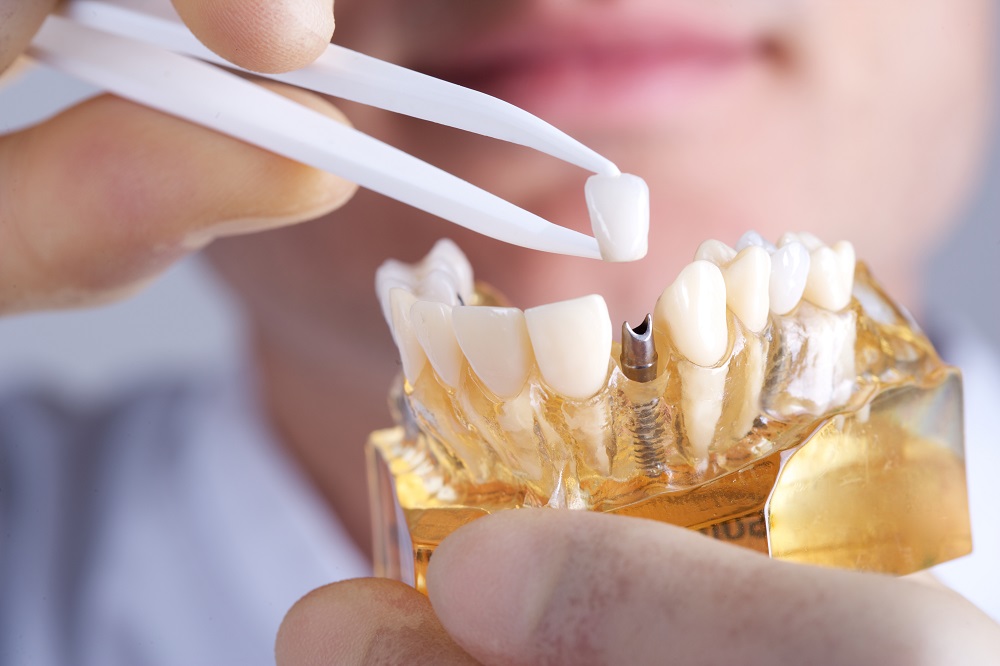 dental implants in Mahogany